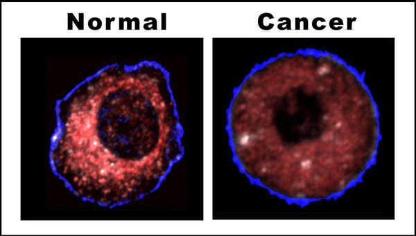 Picture 5 of New ideas can eliminate cancer cell's metastasis