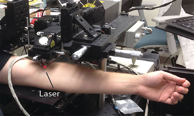 Picture 1 of New laser technology can kill melanoma cells