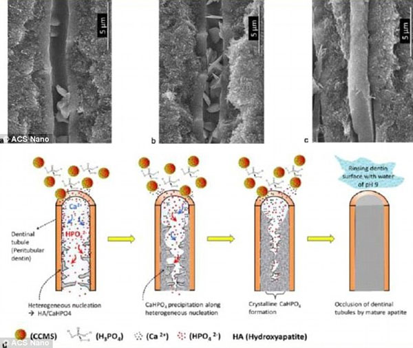 Picture 1 of New materials protect sensitive teeth for a long time