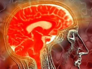 Picture 1 of New method of treating brain tumors does not need to open the skull