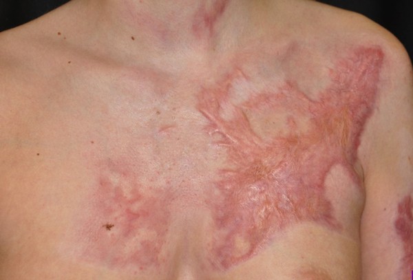 Picture 3 of New method to treat burns without scarring