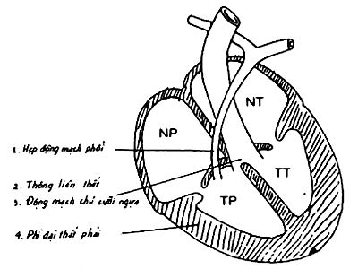 Picture 2 of New surgical method to treat congenital heart disease