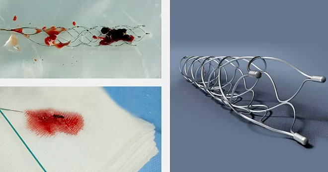 Picture 1 of New technology to save stroke people