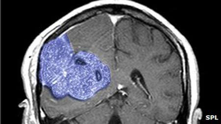 Picture 1 of New therapy, effective in cancer treatment