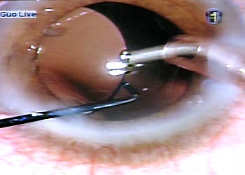 Picture 2 of New treatment for cataracts
