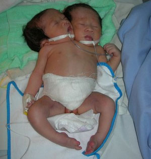 Picture 1 of Newborn baby girls have two heads