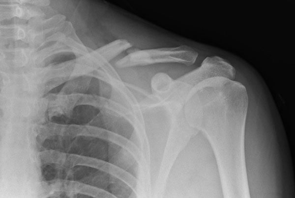 Picture 1 of Nine genes were found to be related to bone density