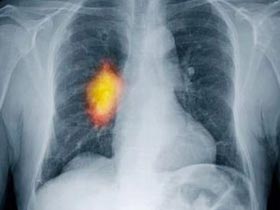 Picture 1 of Non-smokers still have lung cancer