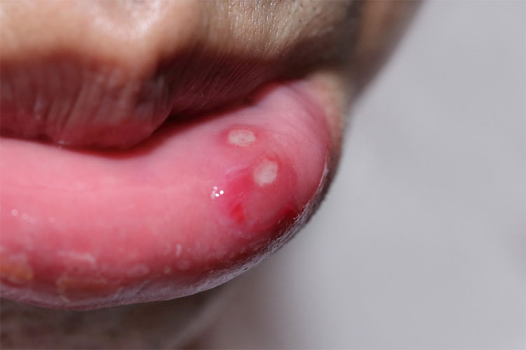 Picture 1 of Oral heat - causes, symptoms and cures
