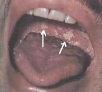 Picture 1 of Oral tissue lesions in children