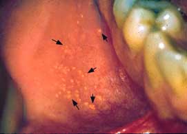 Picture 3 of Oral tissue lesions in children