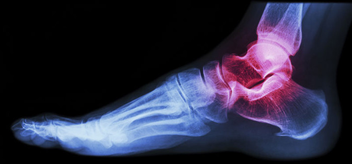 Picture 3 of Our feet are dying from the age of 25 without you knowing