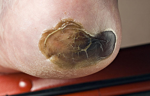 Picture 5 of Our feet are dying from the age of 25 without you knowing
