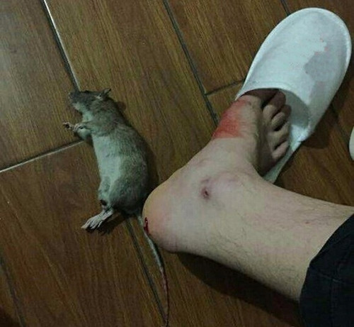 Picture 2 of Overview of mouse bite disease - Sodoku