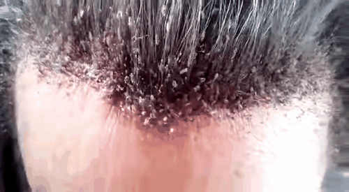 Picture 1 of Pandemic hair is about to explode when 98% of lice are resistant