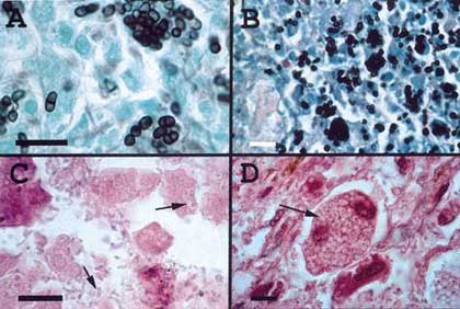 Picture 2 of Panicillium marneffei infection: An AIDS marker