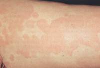 Picture 2 of Patch Test: Test for allergies