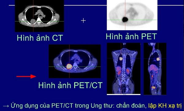 Picture 2 of Patients with lung cancer metastasize throughout the body still cured