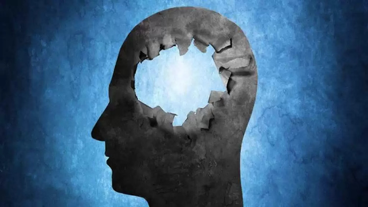 Picture 1 of People born without brains still live healthy, IQ is higher than ordinary people