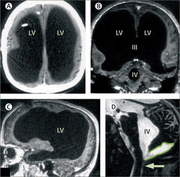 Picture 2 of People born without brains still live healthy, IQ is higher than ordinary people