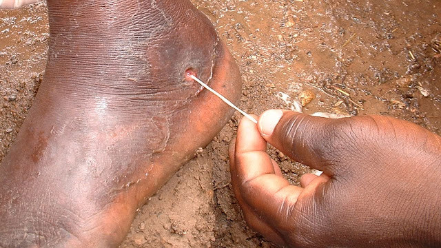 Picture 3 of People will permanently erase the dreaded disease on a global scale