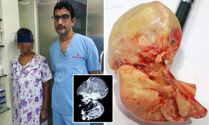 Picture 1 of Petrified fetuses lay 15 years in the 52-year-old woman's belly