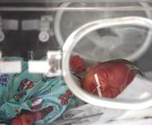 Picture 2 of Pneumococcal pneumonia - Dangerous disease in children