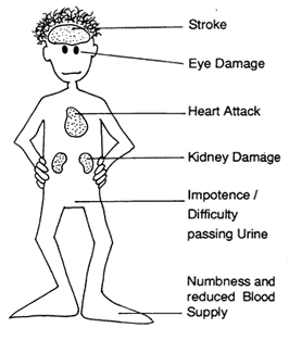 Picture 1 of Potential therapy helps treat diabetes