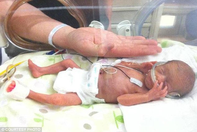 Picture 1 of Premature babies weigh 720g