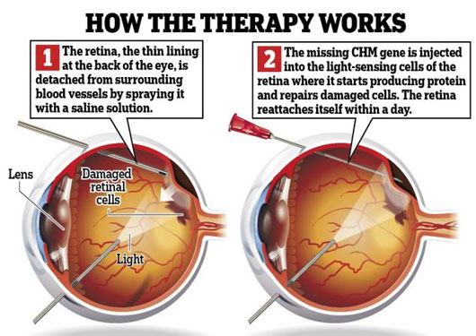 Picture 1 of Prevent blindness by just one shot
