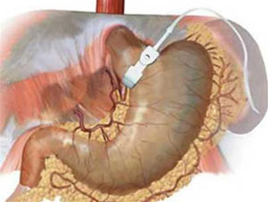Picture 2 of Prevent obesity before ... obesity