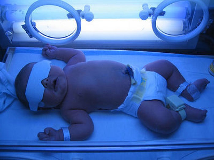 Picture 4 of Preventing jaundice in newborns