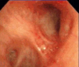 Picture 1 of Prevention and treatment of bronchodilator