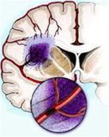 Picture 1 of Prevention and treatment of cerebral circulation disorders in the elderly