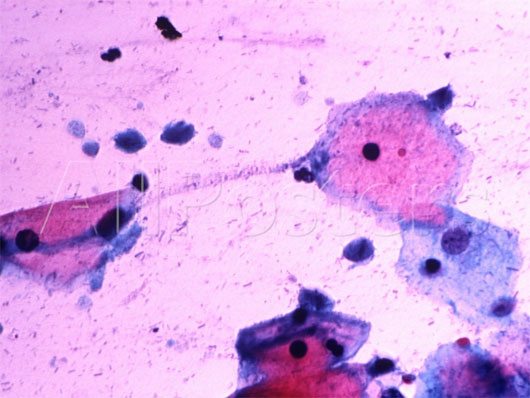 Picture 1 of Prostate cancer may be sexually transmitted