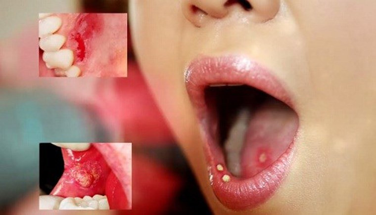 Picture 1 of Quick tips for treating mouth ulcers quickly