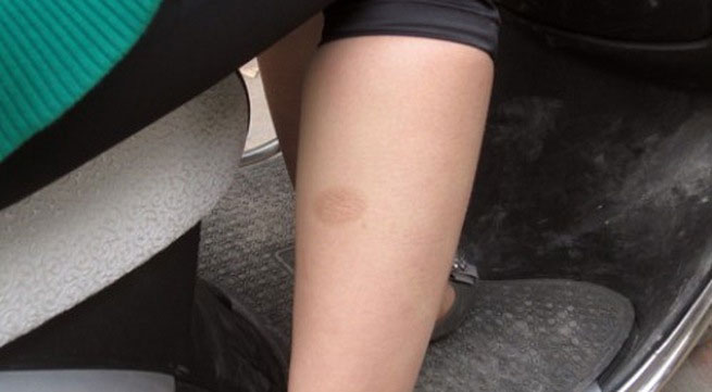 Picture 2 of Quick treatment of burns without scarring