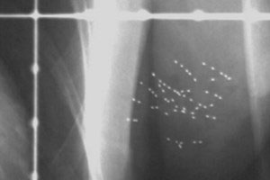 Picture 1 of Radioactive particles can treat the root of breast cancer