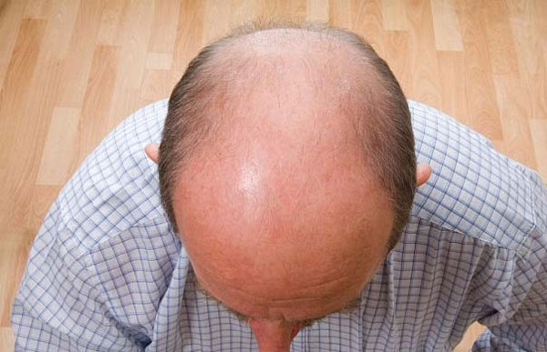 Picture 1 of Random discovery brings good news to bald people