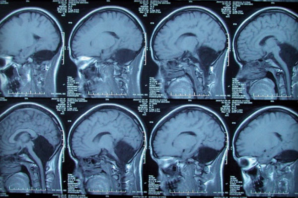 Picture 1 of Rare cases: People born without cerebellum