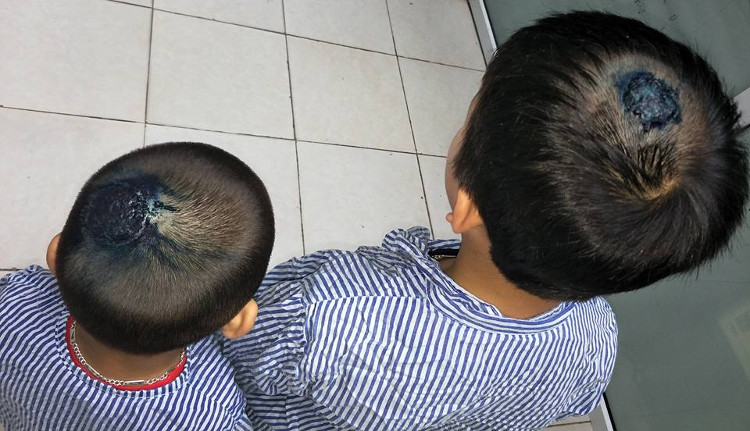 Picture 1 of Rare disease: The head has a honeycomb because of playing with cats and dogs
