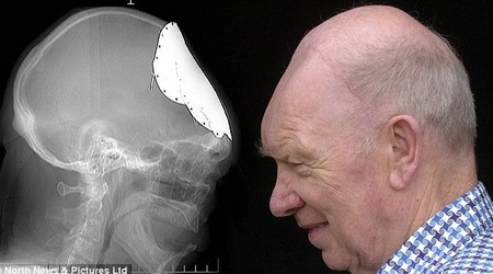 Regrowth of the skull after 5 decades images 1