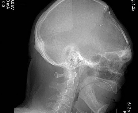 Regrowth of the skull after 5 decades images 2