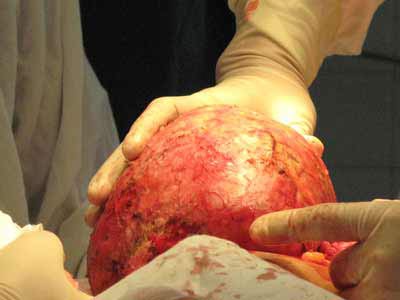Picture 1 of Removing the tumor weighs 7 kg