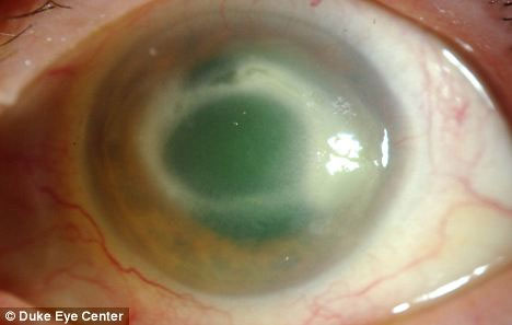 Picture 2 of Risk of blindness due to contact lenses