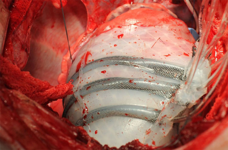 Picture 1 of Robots help patients with heart failure through critical attacks
