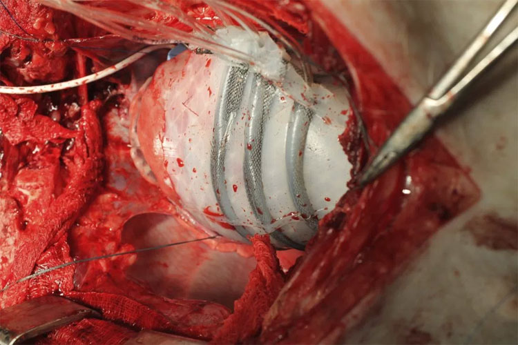Picture 3 of Robots help patients with heart failure through critical attacks