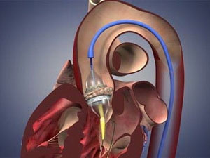 Picture 1 of Russia successfully assembled the latest artificial heart valve model