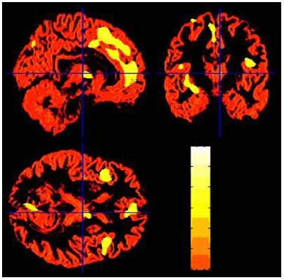 Sad memories change the amount of gray matter in the brain images 1