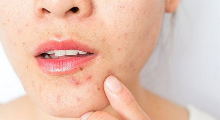 Picture 1 of Scientists are still arguing over what the actual cause of acne is